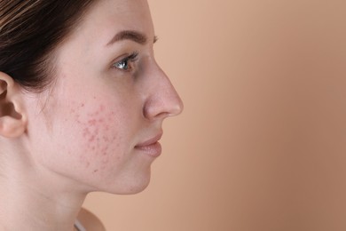 Photo of Young woman with acne problem on beige background, closeup. Space for text