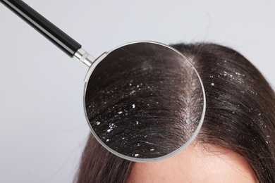 Woman suffering from dandruff on light grey background, closeup. View through magnifying glass on hair with flakes