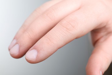 Photo of Woman with dry skin on hand against light background, closeup