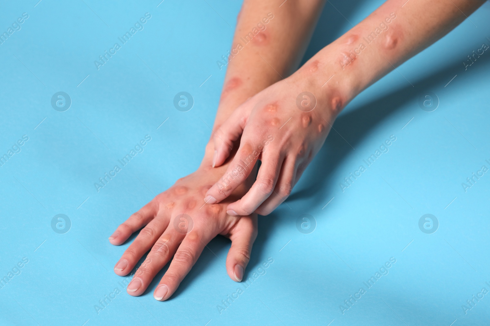 Photo of Woman with rash suffering from monkeypox virus on light blue background, closeup