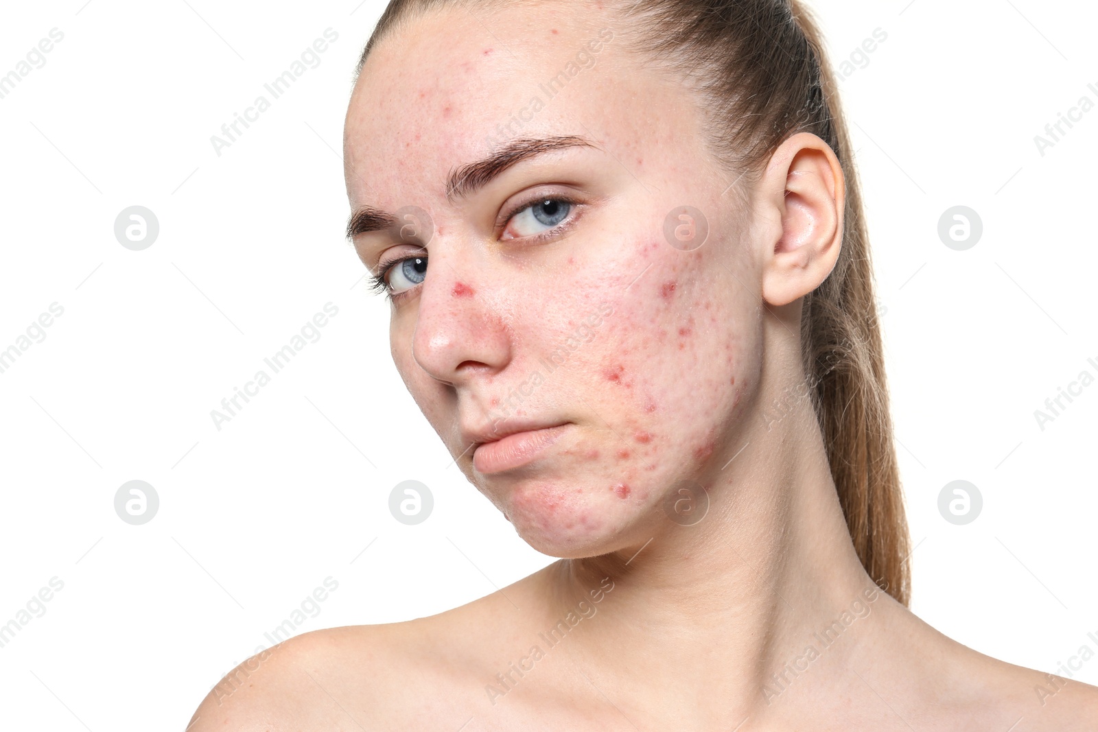 Photo of Young woman with acne problem on white background