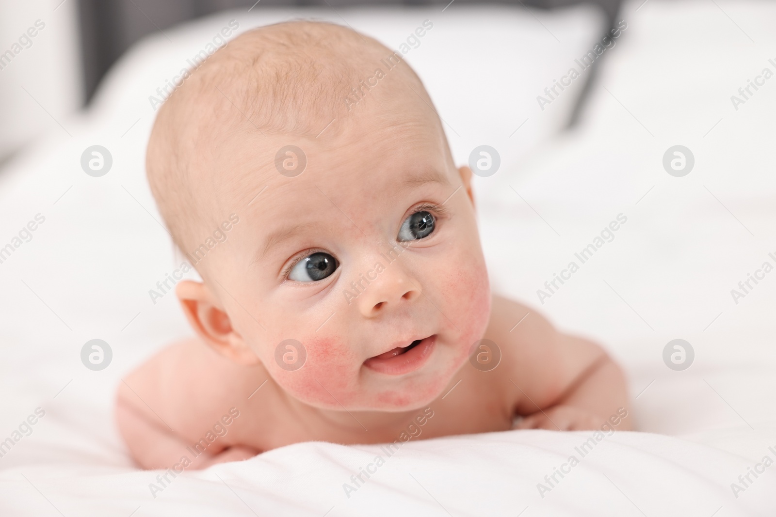 Photo of Cute little baby with allergic redness on cheeks lying on bed at home