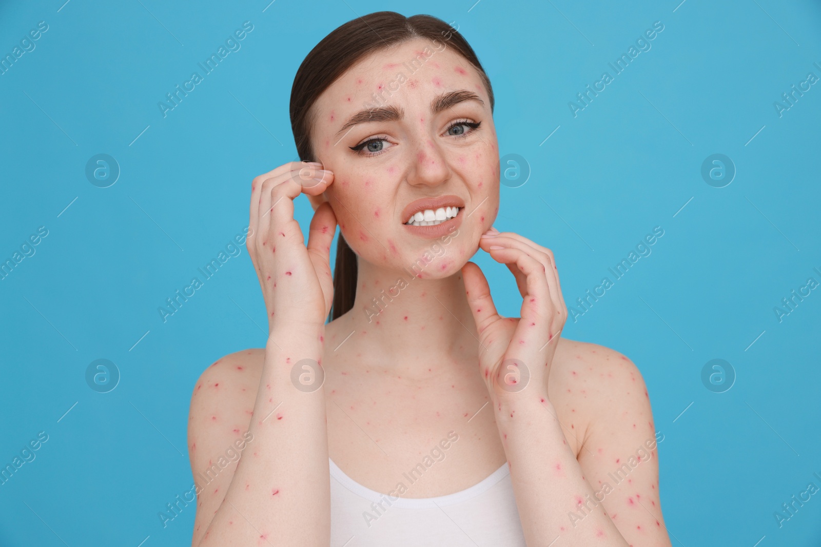 Photo of Woman with rash suffering from monkeypox virus on light blue background