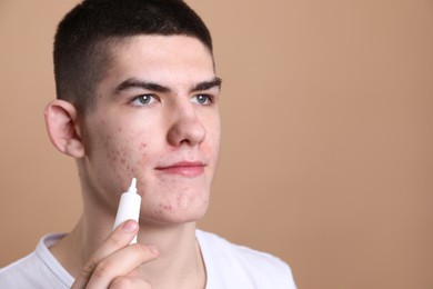 Photo of Young man with acne problem applying cosmetic product onto his skin on beige background. Space for text