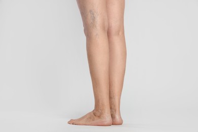Photo of Closeup view of woman with varicose veins on light background