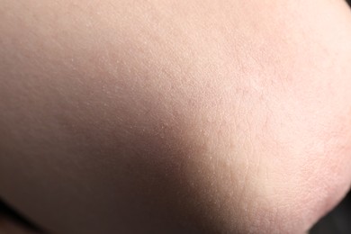 Woman with dry skin on elbow, closeup