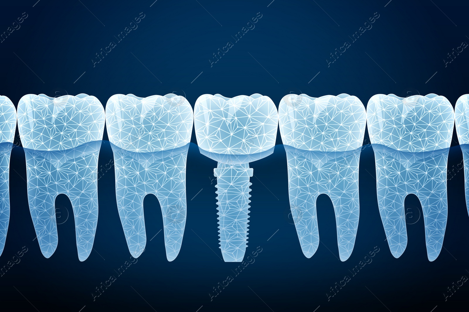 Illustration of  teeth and dental implant on dark blue background