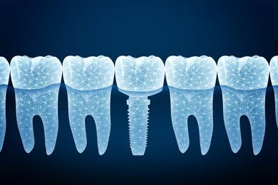 Illustration of  teeth and dental implant on dark blue background