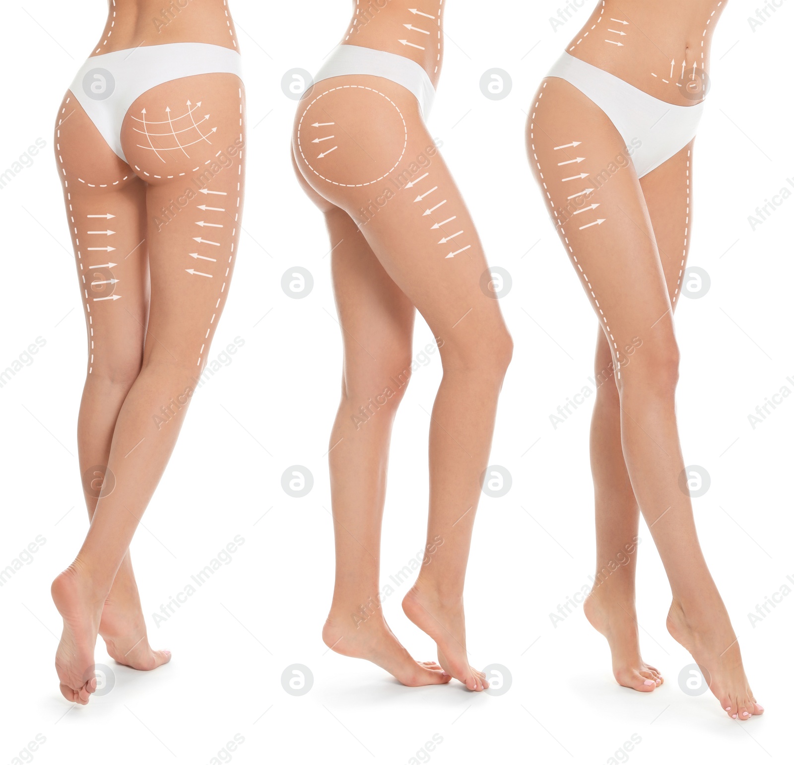 Image of Photos of young woman with marks on body against white background, collage. Cosmetic surgery concept