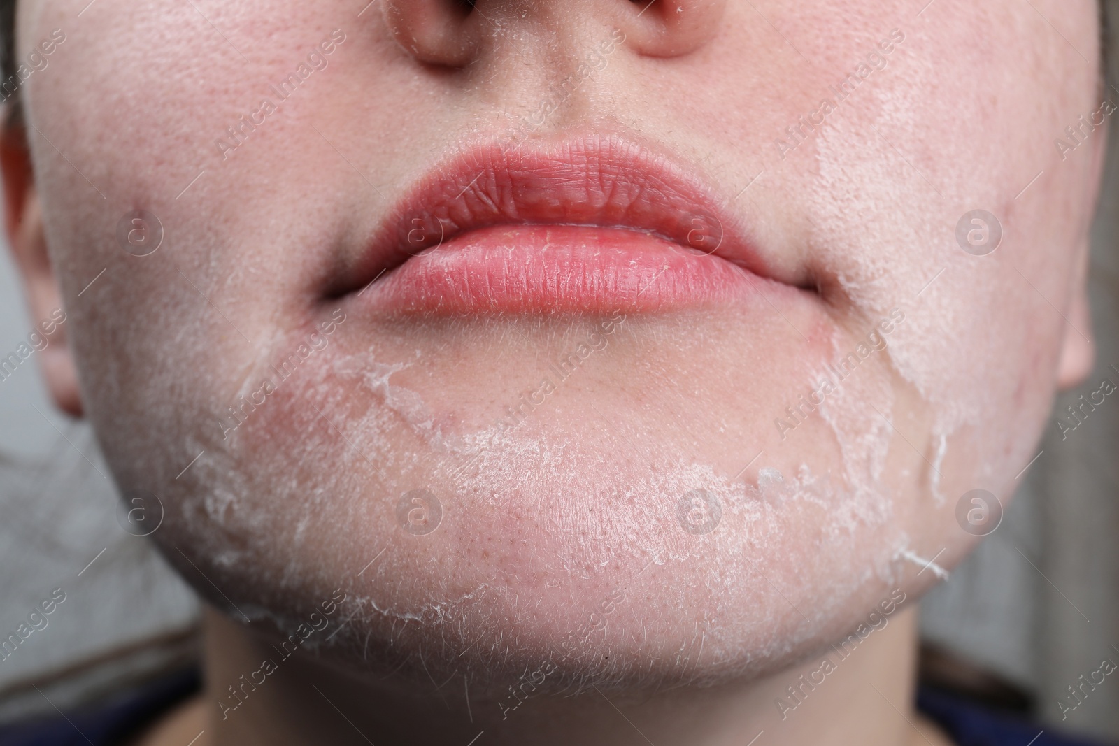 Photo of Woman with dry skin on face, closeup