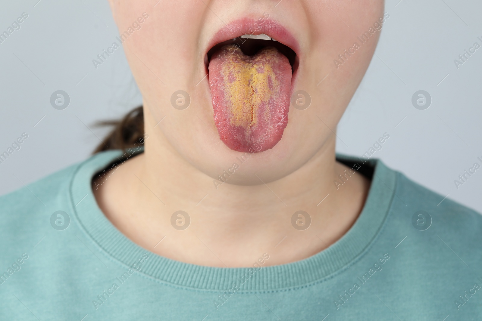 Photo of Gastrointestinal diseases. Woman showing her yellow tongue on light grey background, closeup