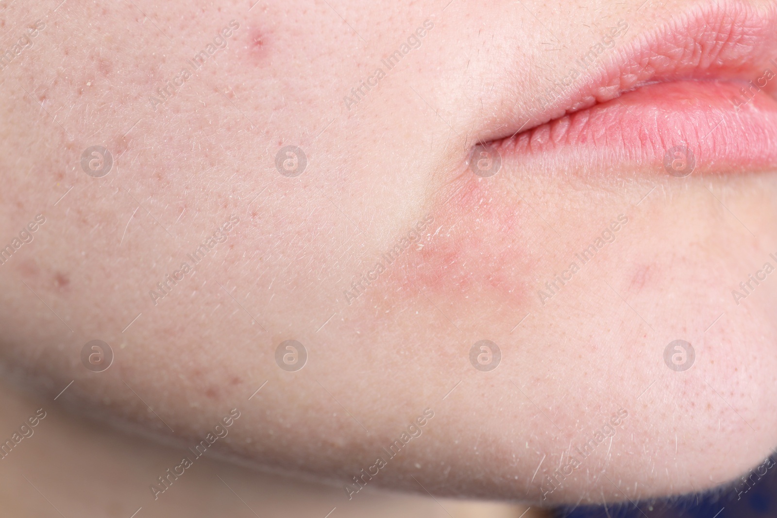 Photo of Woman with dry skin on face, closeup