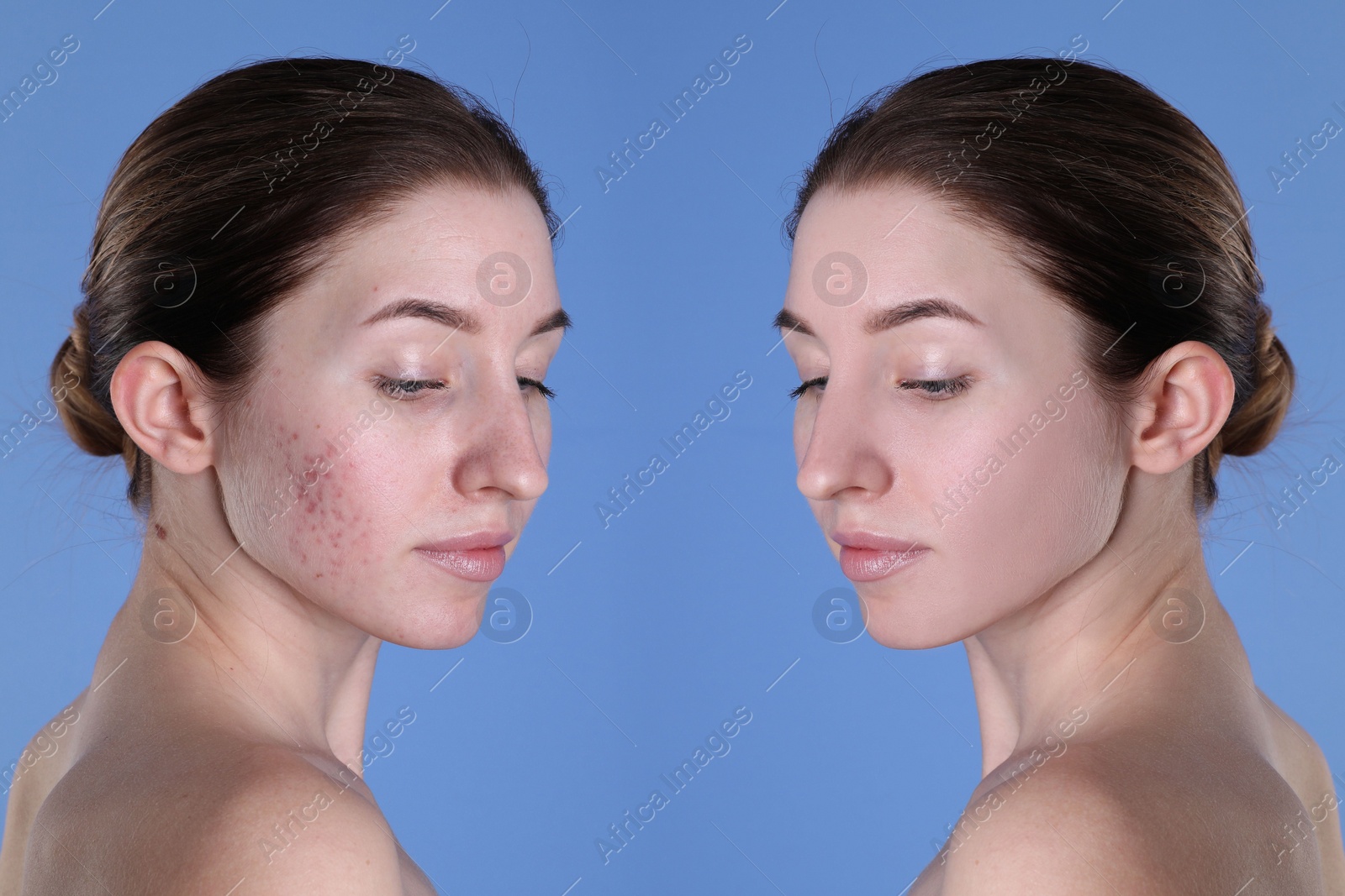 Image of Acne problem. Young woman before and after treatment on blue background, collage of photos