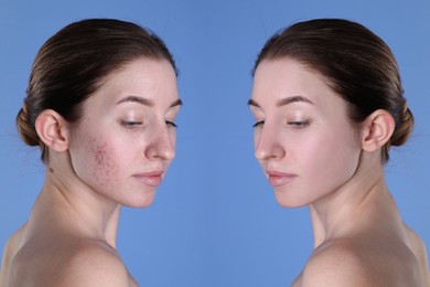 Acne problem. Young woman before and after treatment on blue background, collage of photos