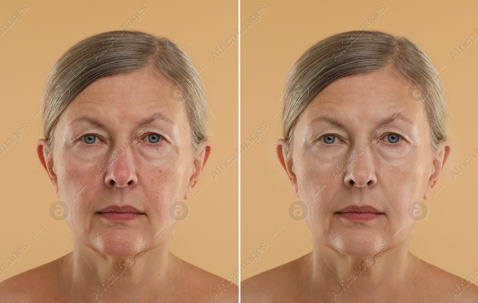 Image of Aging skin changes. Collage with photos of mature woman before and after cosmetic procedure on beige background