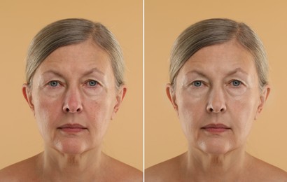 Image of Aging skin changes. Collage with photos of mature woman before and after cosmetic procedure on beige background