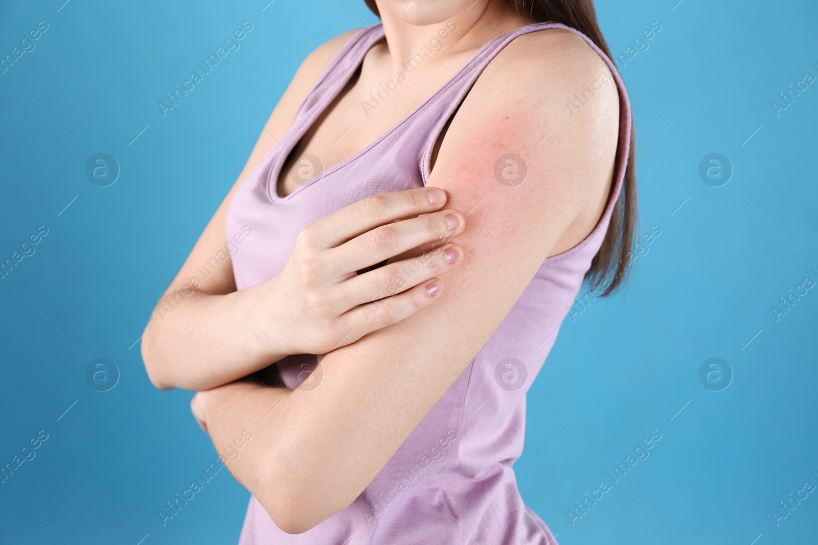 Photo of Young woman scratching hand on color background, closeup. Allergies symptoms