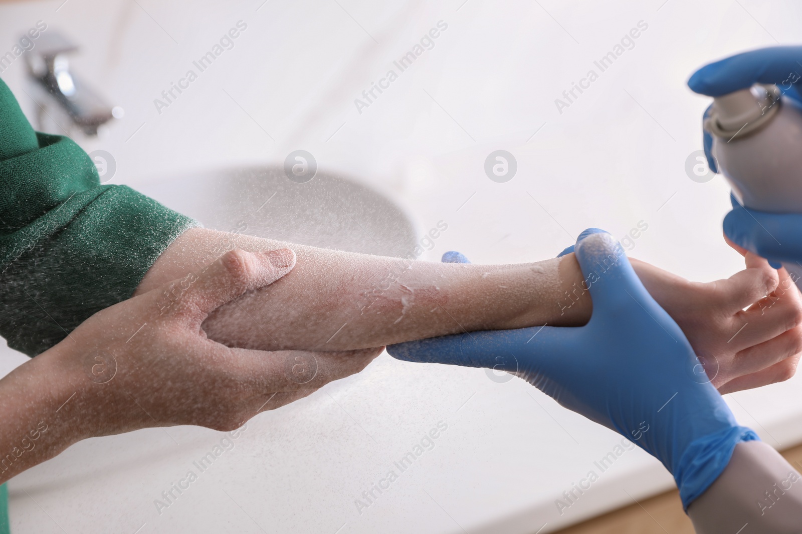 Photo of Applying burn spray onto injured skin, closeup