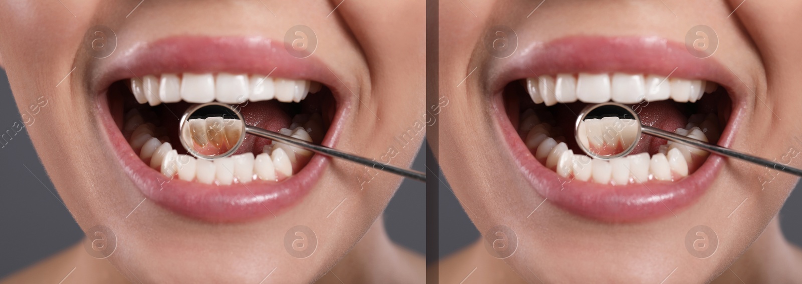 Image of Collage with photos of woman before and after professional treatment of dental plaque, closeup. Banner design