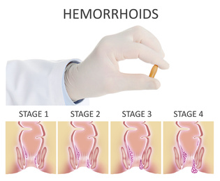Doctor holding suppository for hemorrhoid treatment over illustration of lower rectum progressing disease