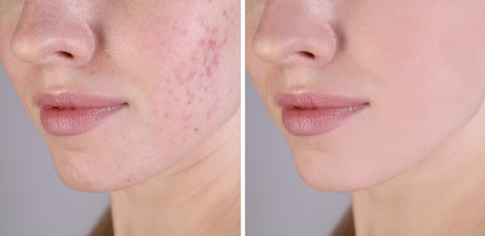 Acne problem. Young woman before and after treatment on grey background, closeup. Collage of photos