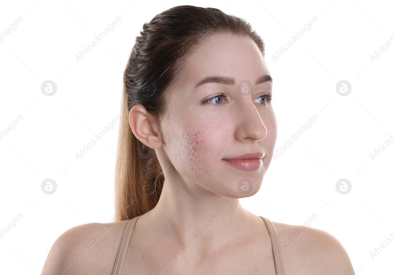 Photo of Young woman with acne problem on white background