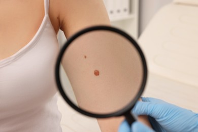 Dermatologist examining patient's birthmark with magnifying glass indoors, closeup