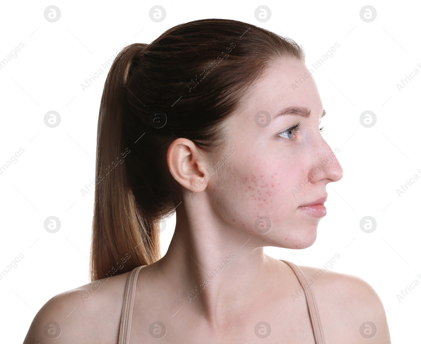 Photo of Young woman with acne problem on white background