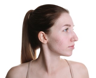 Young woman with acne problem on white background