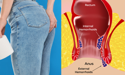 Woman with toilet paper suffering from hemorrhoid pain, closeup. Illustration of unhealthy lower rectum