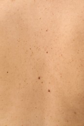 Photo of Closeup of woman's body with birthmarks as background