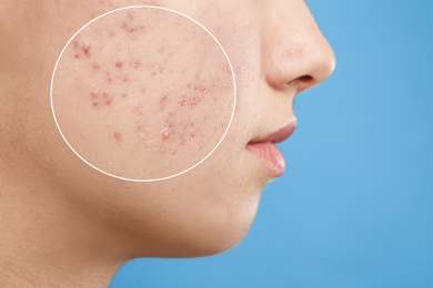 Image of Teenage girl with acne problem on blue background, closeup