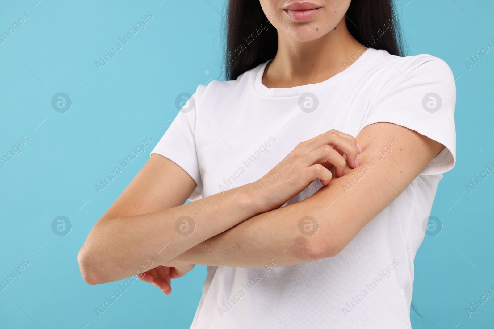 Photo of Suffering from allergy. Young woman scratching her arm on light blue background, closeup