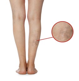 Woman suffering from varicose veins on white background, closeup. Magnified skin surface showing affected area