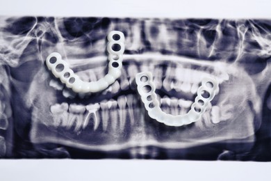 Mouth guards on dental scan, flat lay. Bite correction