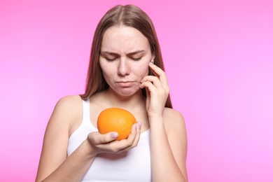 Young woman with acne problem holding orange on color background. Skin allergy