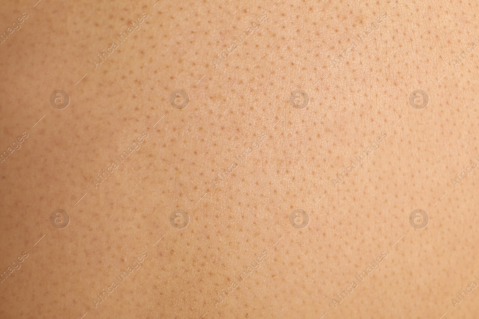 Photo of Texture of human skin with birthmarks, closeup view