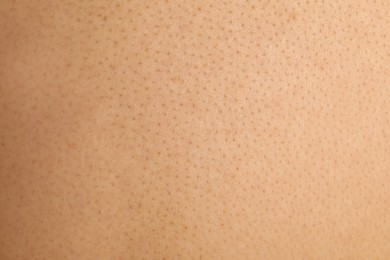 Texture of human skin with birthmarks, closeup view