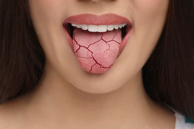 Image of Dry mouth symptom. Woman showing dehydrated tongue, closeup