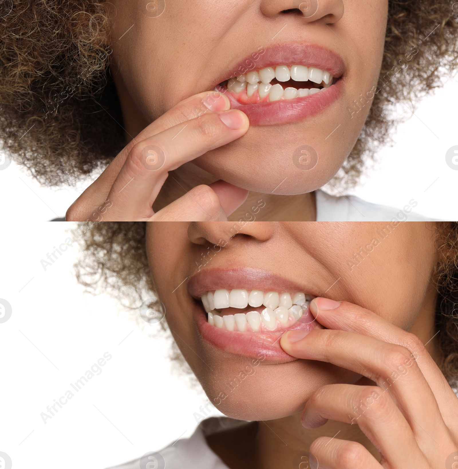 Image of Woman showing gum before and after treatment on white background, collage of photos