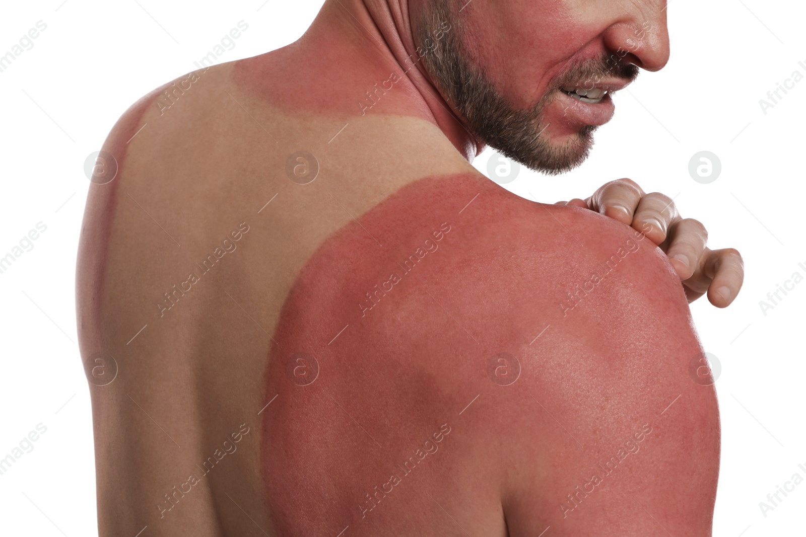 Photo of Man with sunburned skin on white background, closeup