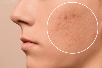 Image of Teenage boy with acne problem on beige background, closeup