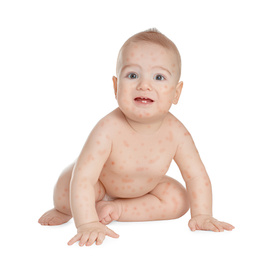Image of Little child with red rash on white background. Baby allergies