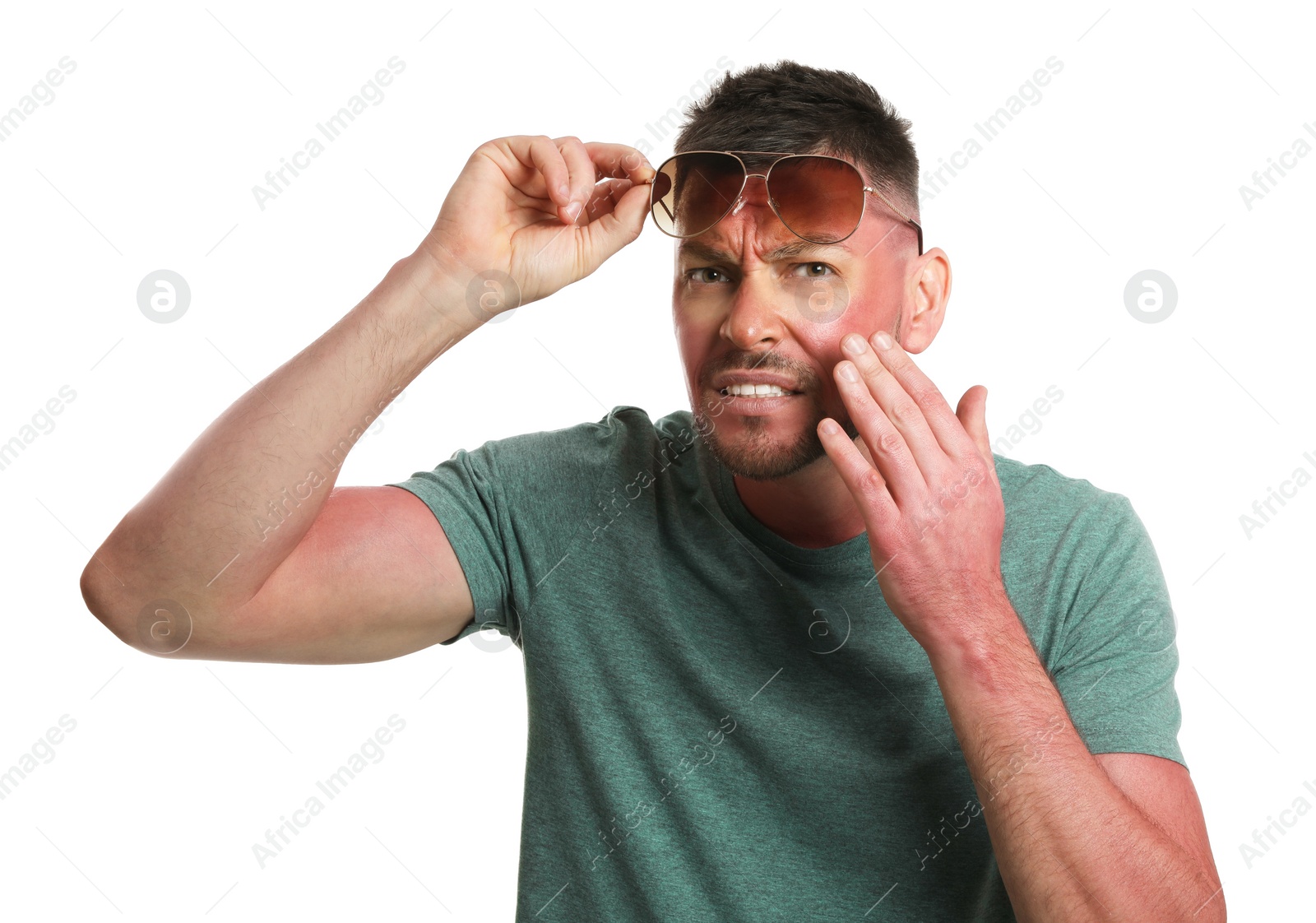 Photo of Man with sunburned skin on white background