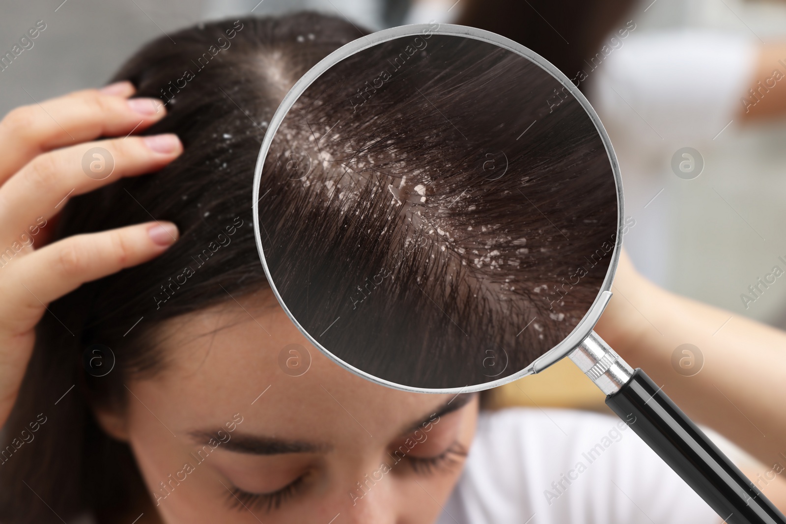 Image of Woman suffering from dandruff on blurred background, closeup. View through magnifying glass on hair with flakes