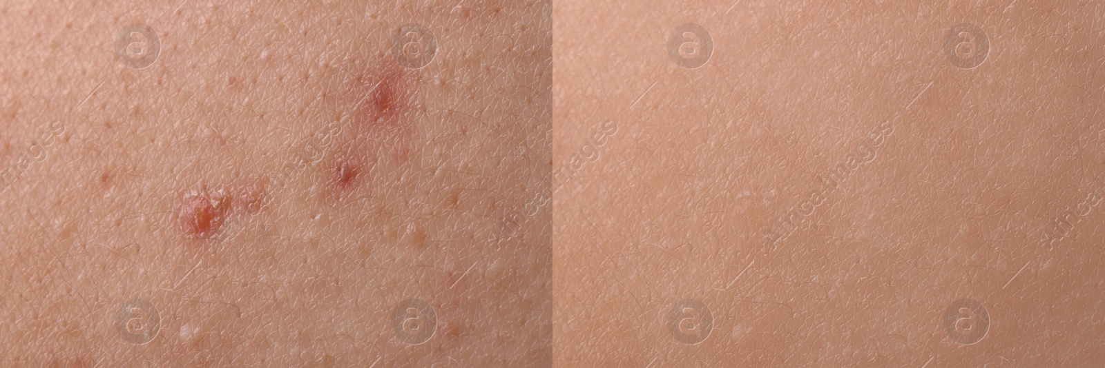 Image of Collage with photos of person suffering from acne before and after treatment, closeup. Banner design showing affected and healthy skin