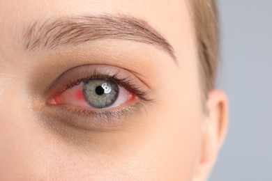 Image of Woman suffering from conjunctivitis on grey background, closeup of red eye