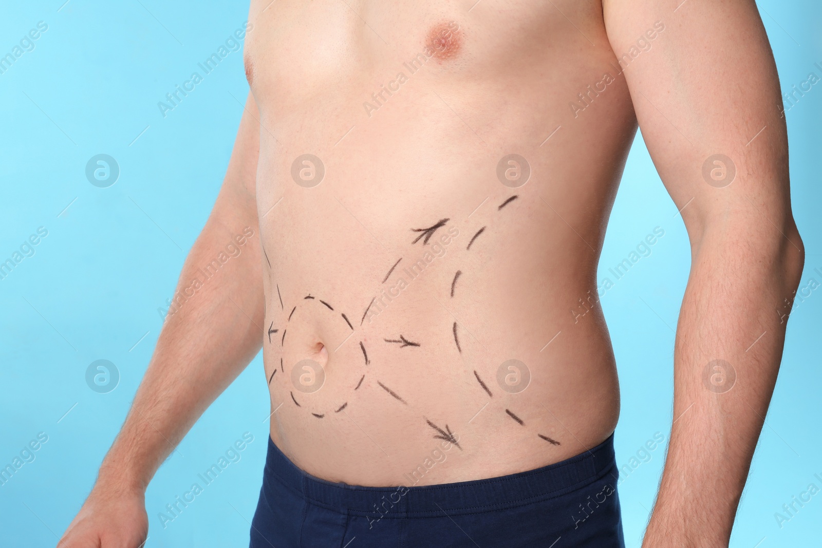 Photo of Man with marks on belly for cosmetic surgery operation against blue background, closeup