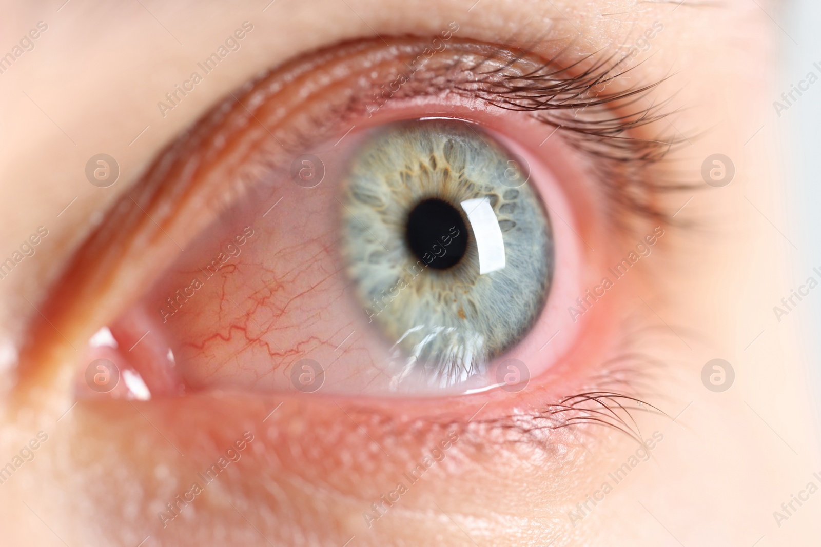 Image of Woman with red eye suffering from conjunctivitis, closeup