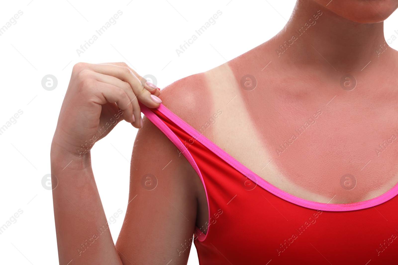 Photo of Woman with sunburned skin on white background, closeup